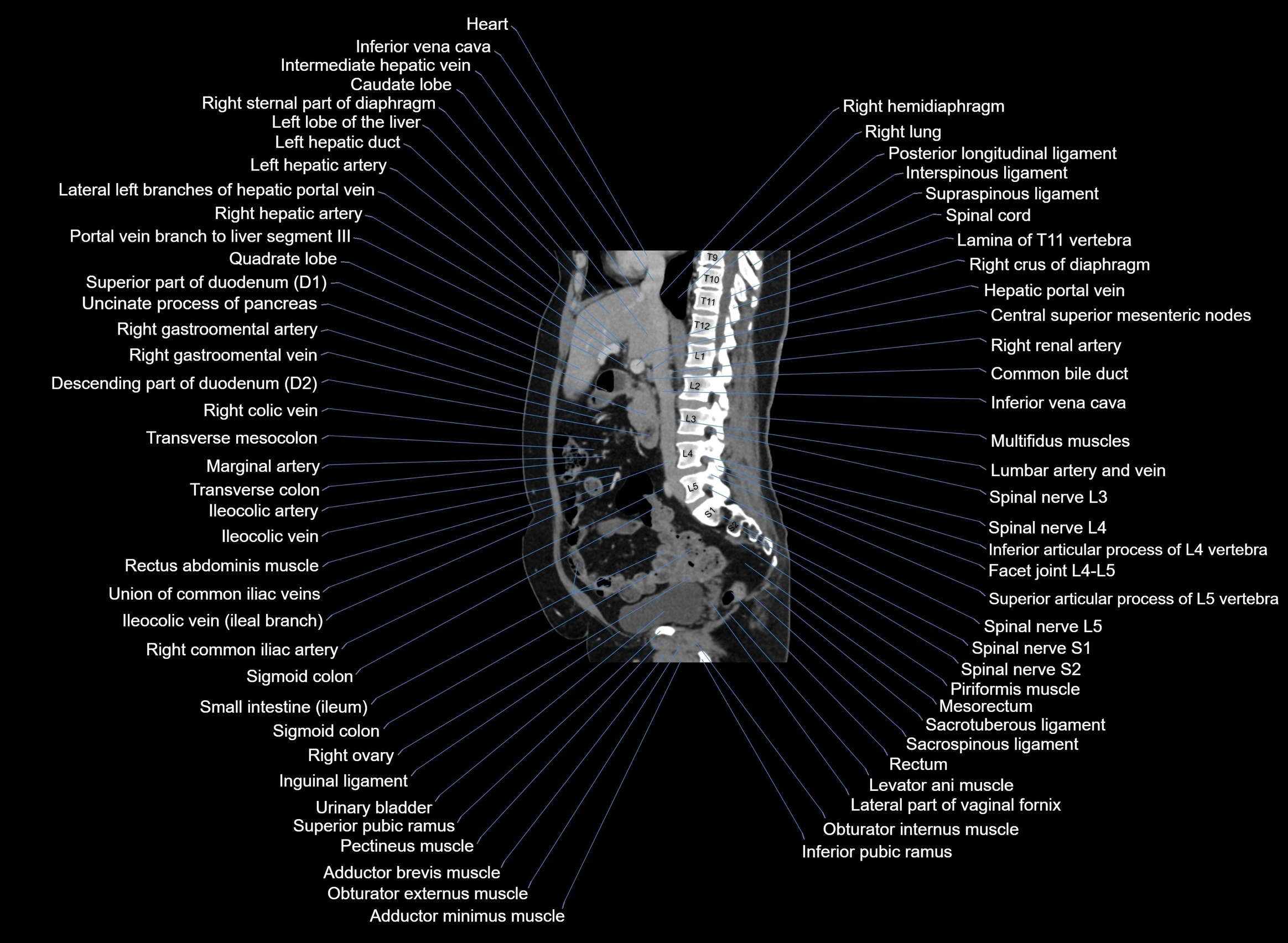 CT Abdomen sagittal cross sectional anatomy labelled radiology image -00066.webp